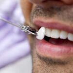 أسعار فينير الاسنان في تركيا - الأنواع والإستخدامات والتركيب